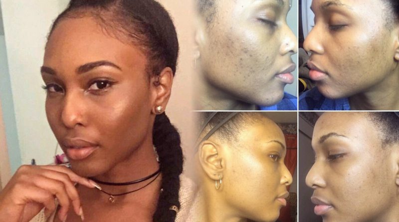 MY SKIN ROUTINE| Healing Hyperpigmentation