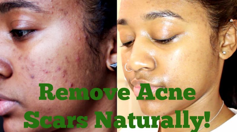 How to: Remove My Acne Scars Naturally| Essential Oils, Derma Roller + More!