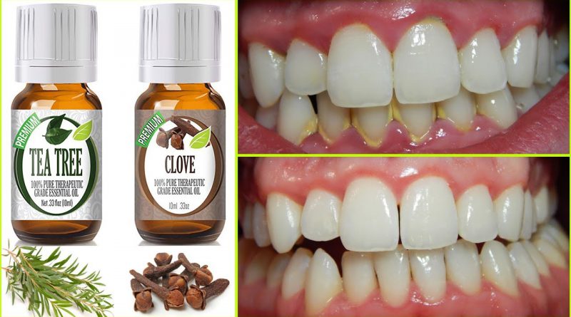 Rub These Two Oils On Your Gums And Teeth And You Probably Will Not Need To Go A Dentist Again