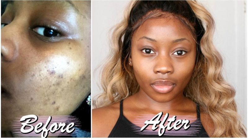 How to: treat dark marks fast routine 2017 | Lizzie Loves Skincare