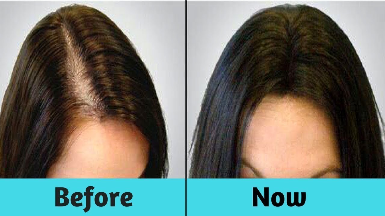 How To Use Peppermint Oil To Stop Hair Loss – Anita Fincham