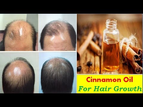 Cinnamon Essential Oil For Hair Growth - Hair Loss-Dandruff  | Natural Treatment- Home Remedies