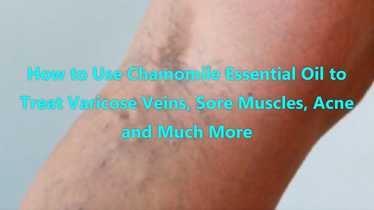 How to Use Chamomile Essential Oil to Treat Varicose Veins, Sore