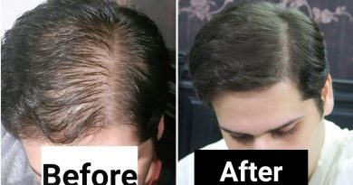 Rosemary Oil for Hair Loss - My Results w/ Pictures Before & After - How To Use