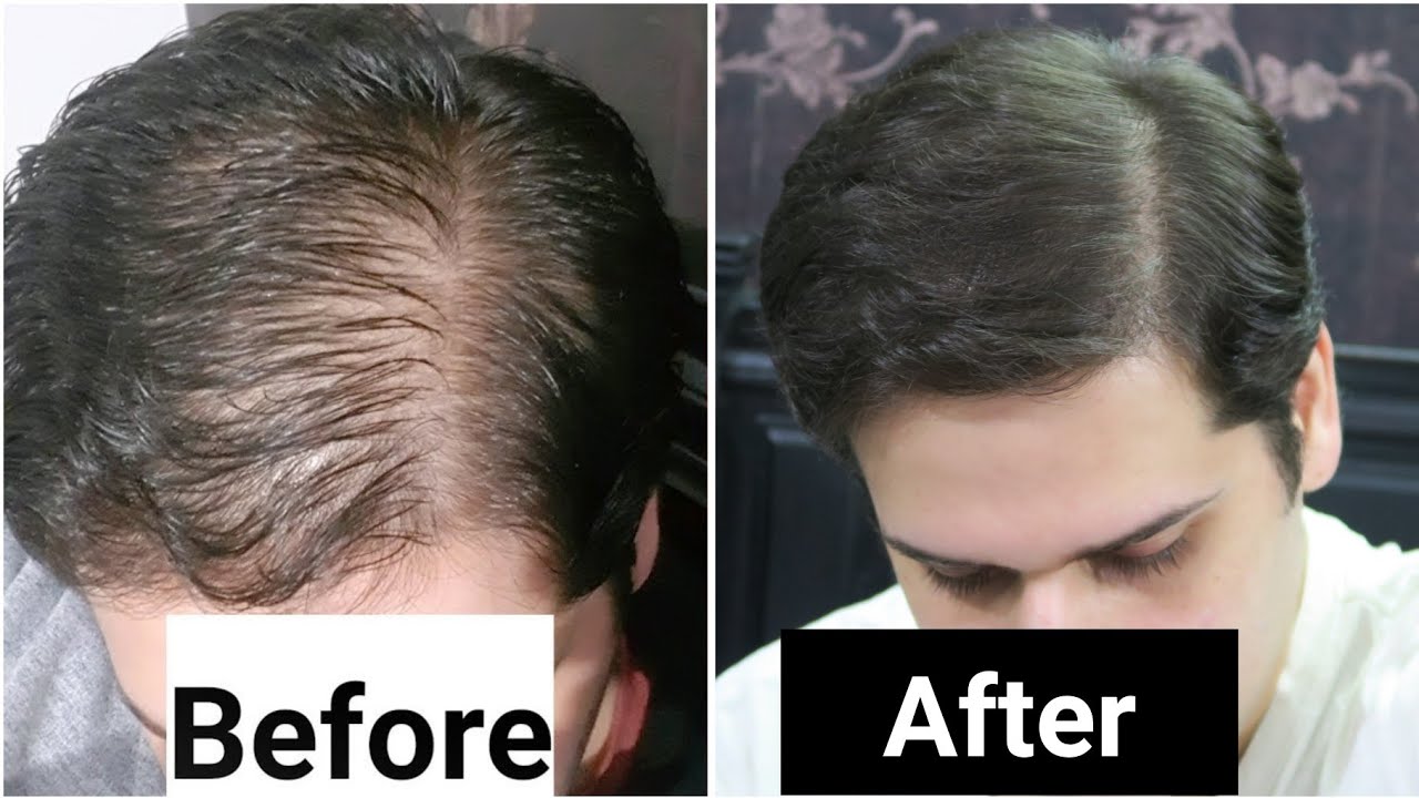 rosemary-oil-for-hair-loss-my-results-w-pictures-before-after